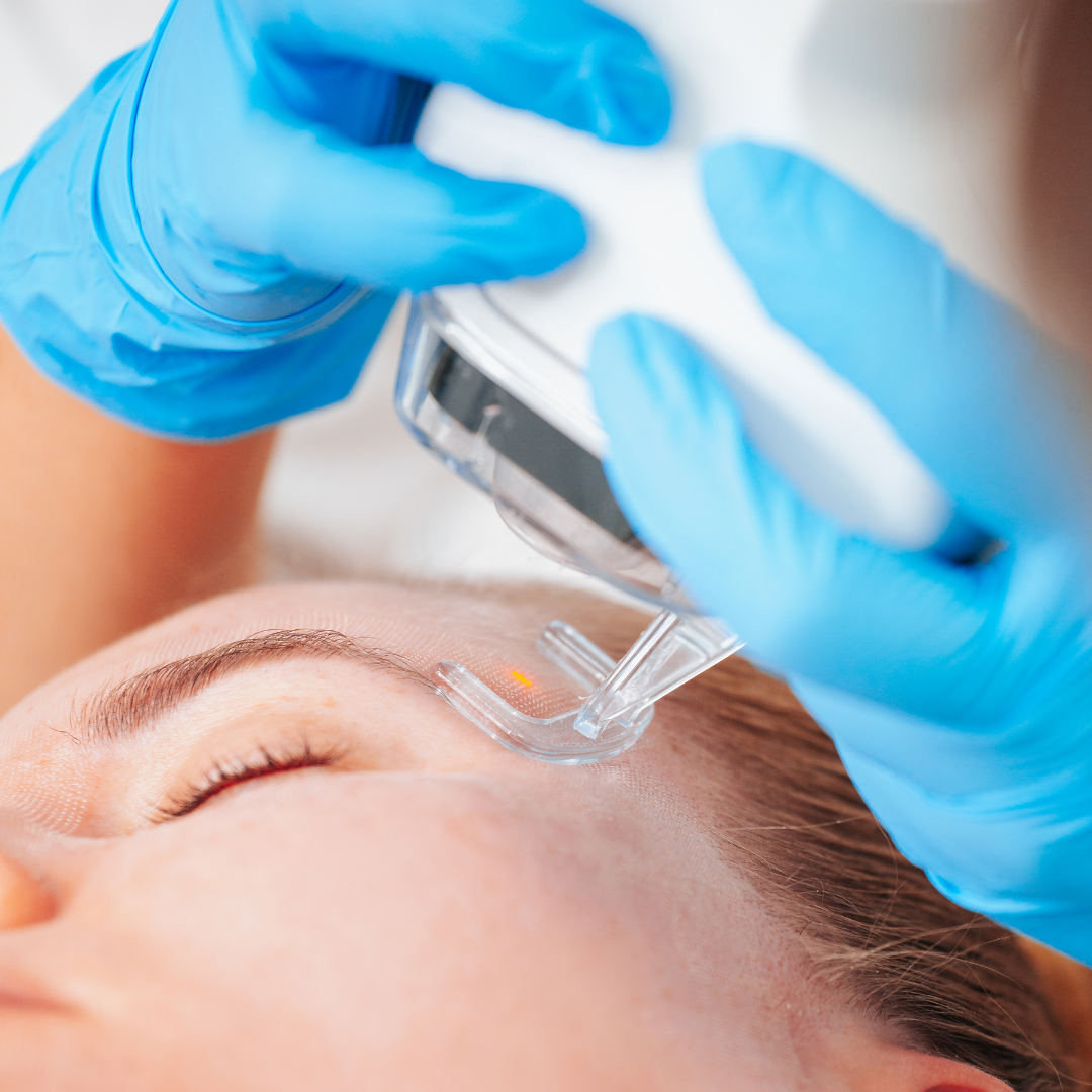 Close-up of a person lying down while a clinican in blue gloves uses an ablative laser on their face